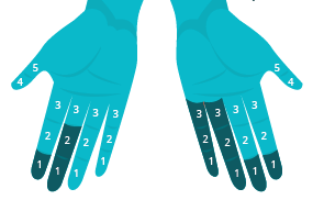 stockholm sensorineural staging system graphic