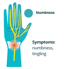 a hand showing a nerve running through it with swelling at the wrist and numbness