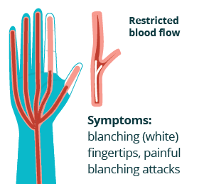 hand showing blood vessels getting restricted resulting in white (blanched) fingers